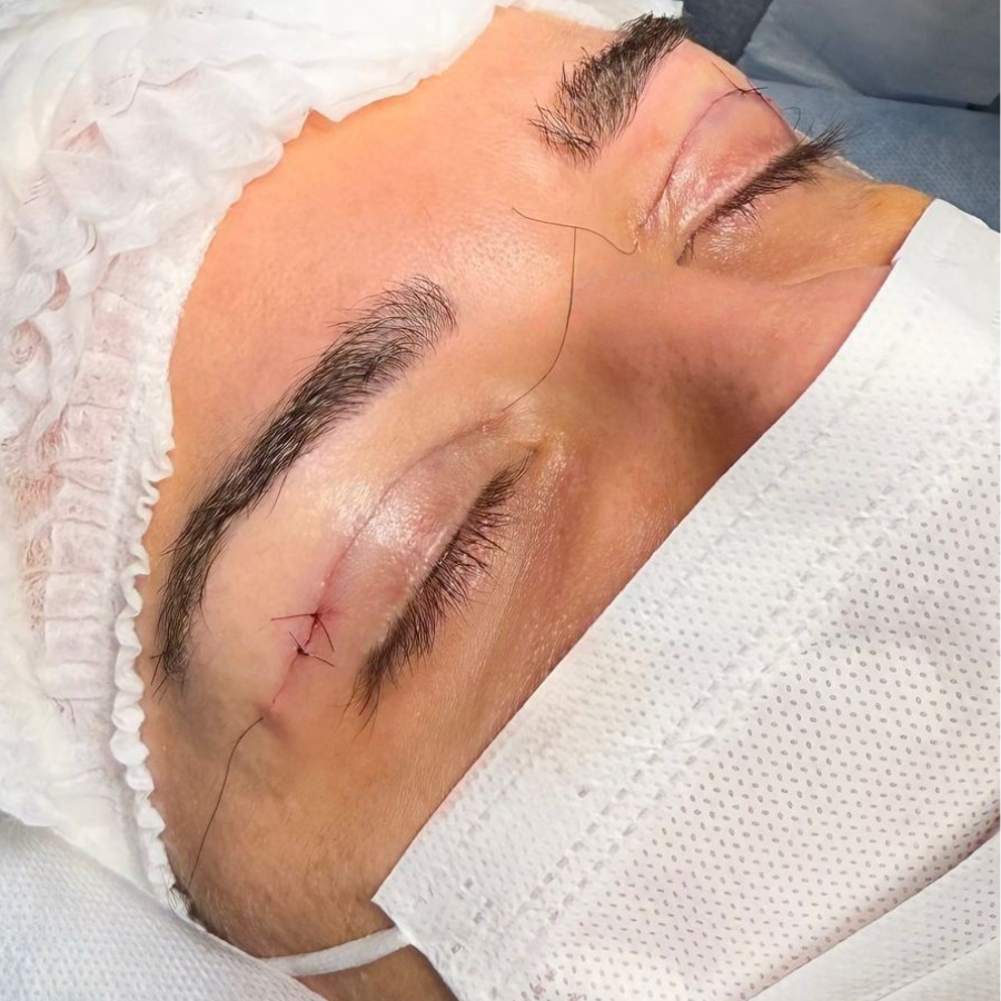 Sutura intradérmica — cicatriz discreta na dobra da pálpebra